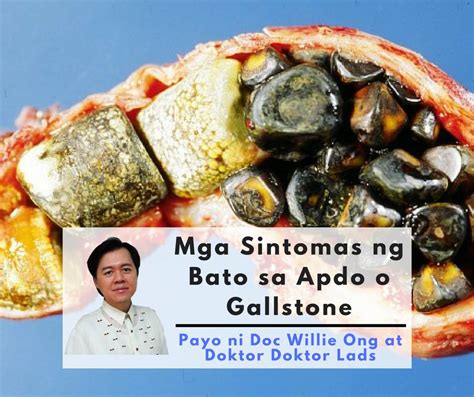 Gallbladder Stone (<strong>Bato sa Apdo</strong>) at Fatty Liver: Tamang Kaalaman. . Nakakamatay ba ang bato sa apdo